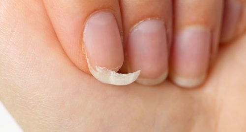 broken or cracked natural nail