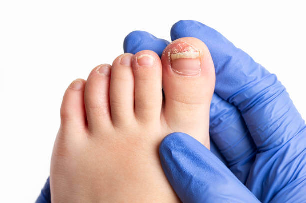 acrylic ruin toe nails, damage cure by a pedicurist